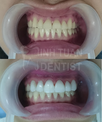 Verneer thay đổi màu và hình dáng răng