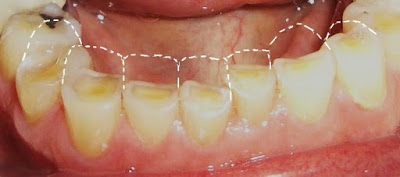 hậu quả của nghiến răng