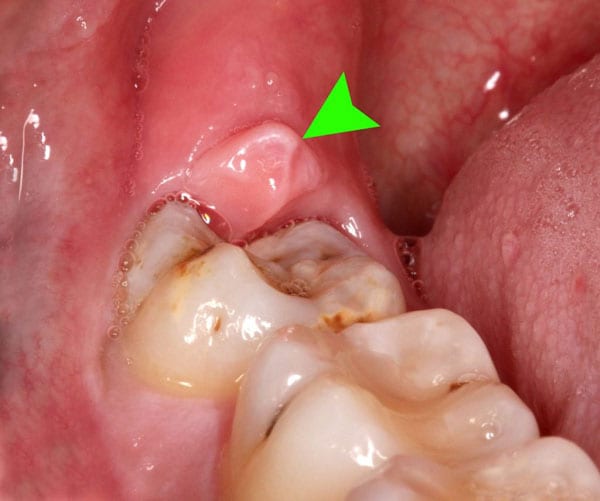 Viêm lợi trùm răng khôn biến chứng