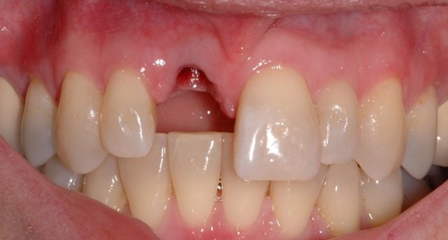 Chấn thương răng cửa rơi ra ngoài và cách xử trí? » Minh Tuan Dentist