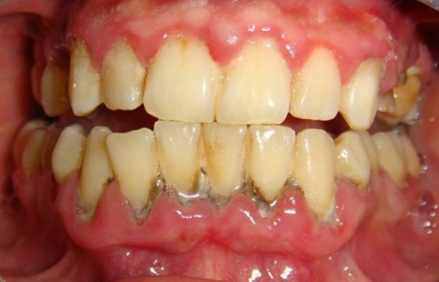 vôi răng gây viêm nướu